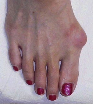 美丽的代价拇外翻