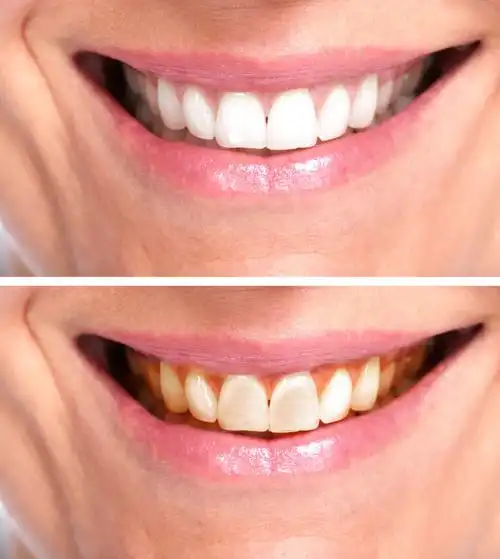 健康的女性牙齿.