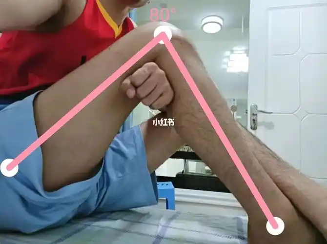 9号,术后2个月忐忑来找医生复查,按照医生要求把被动弯曲角度下到90度