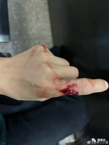 宿州女子远嫁异乡惨遭家暴举着血淋淋的手指求助