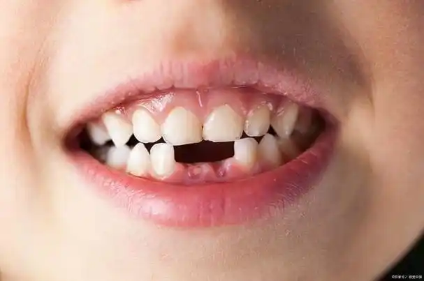牙齿缺失修复方法大揭秘
