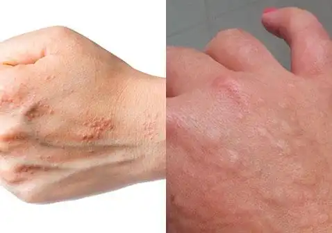 湿疹(图左)和荨麻疹(图右)的对比图片湿疹和荨麻疹都是过敏性皮肤病.