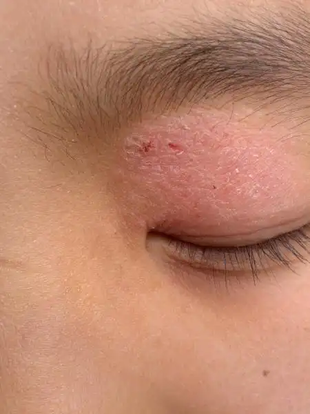 27十岁儿童,左眼上眼皮一皮损,五岁时就有,时好时坏,用点皮康王, 皮炎