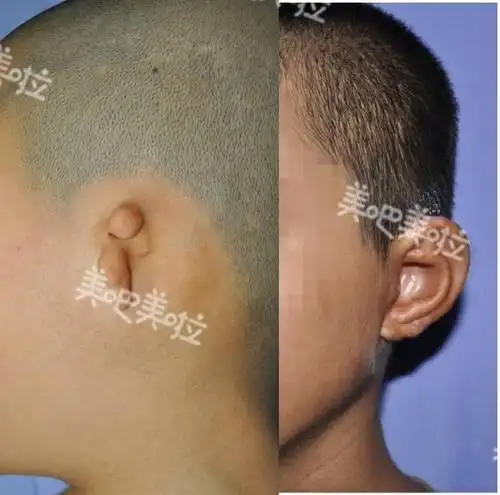 这些孩子天生没有耳朵,大豫网公益救助正式启