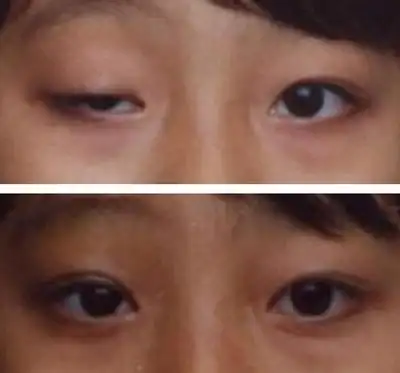 上眼睑肌无力对视力有什么影响?中医辨证说给你听