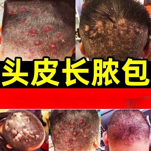 疙瘩毛囊焱头皮长红疙瘩痘痘脓包头皮发痒流脓结痂红斑刺疼反复发作