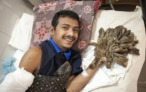 男子患怪病手脚像树根 全世界仅发现三例