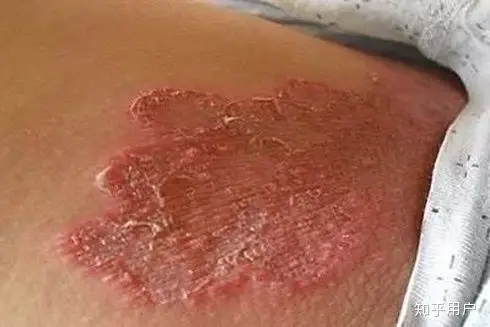 请问我这个是股藓还是湿疹?(有图慎入)?