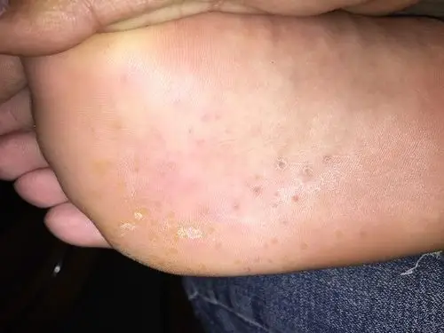 我脚底这是什么东西 有点痒 哪位医生帮我看看