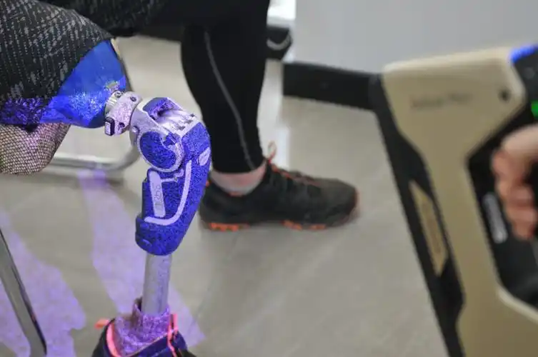 先临三维案例三维扫描技术带来假肢外壳新时尚