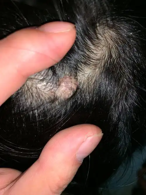 头皮上长了这个肉疙瘩越来越大了,还比较痒,这需要怎么治疗?