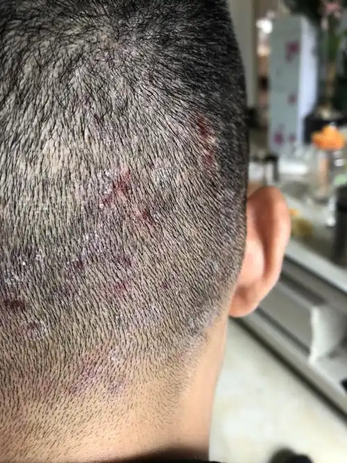 后脑勺长的这个是什么?有什么办法治好