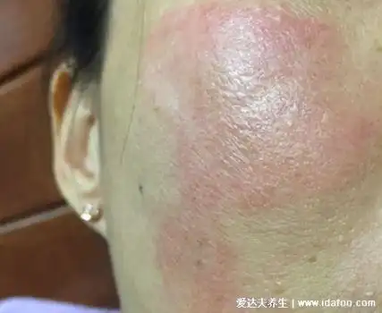 皮炎和湿疹区别图片,湿疹可发于成人头部四肢100种皮肤病对照图片