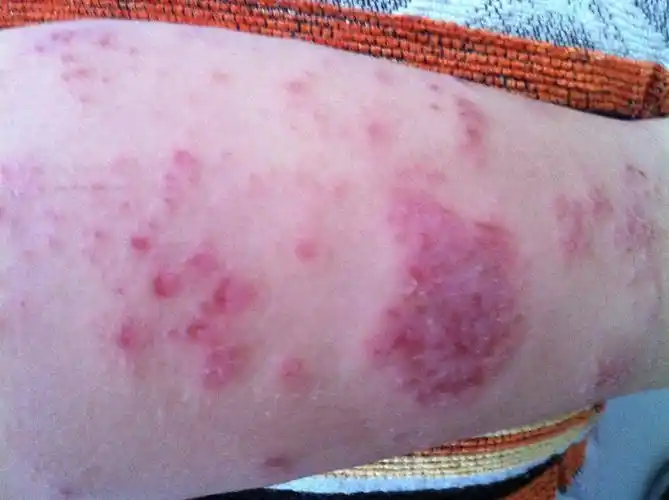 金属性荨麻疹的症状