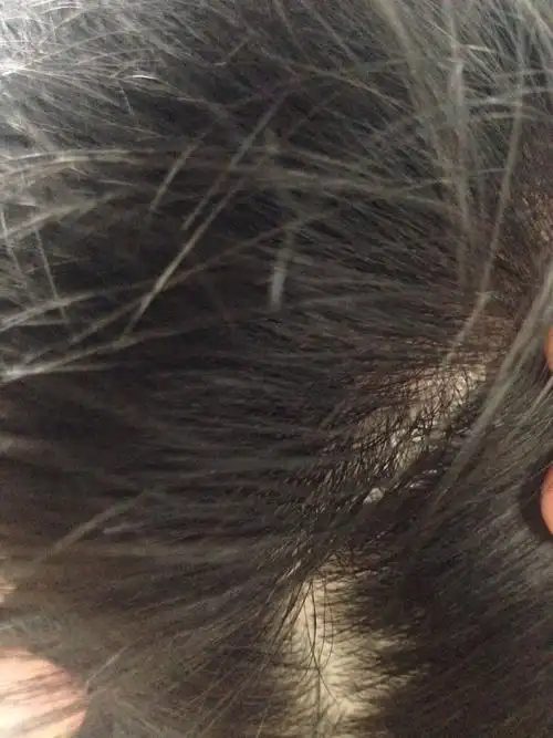 头皮发痒,特别痒,只是痒.有些地方发红