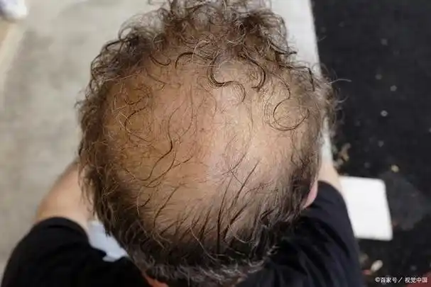 为什么男性型脱发多发生在头顶和头顶两侧?