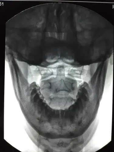 原创寰枢关节前倾错位--头痛失眠头晕颈部压迫感呼吸吞咽困难