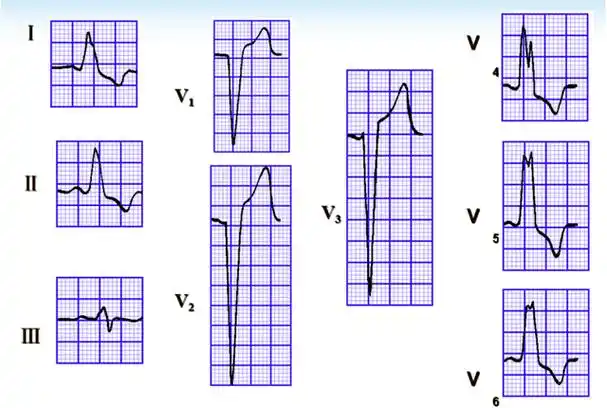 什么是大炮音,大炮音是怎样产生的(心律失常 五>)