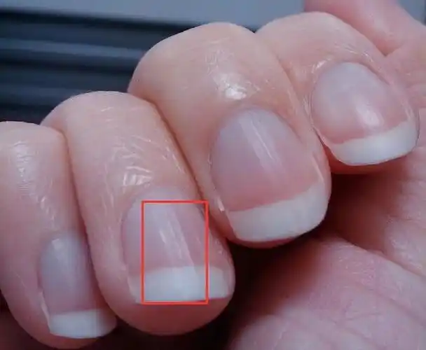 头条创作挑战赛#竖纹是指甲上的一种常见现象,它指的是指甲表面诚现