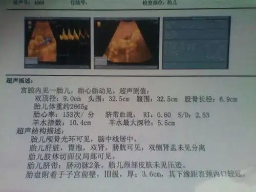 过了两个月吧,到了作"四维"的时候,四维本是一次排畸的检查,但是很多