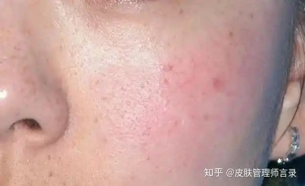 皮肤屏障受损自救指南一看就会