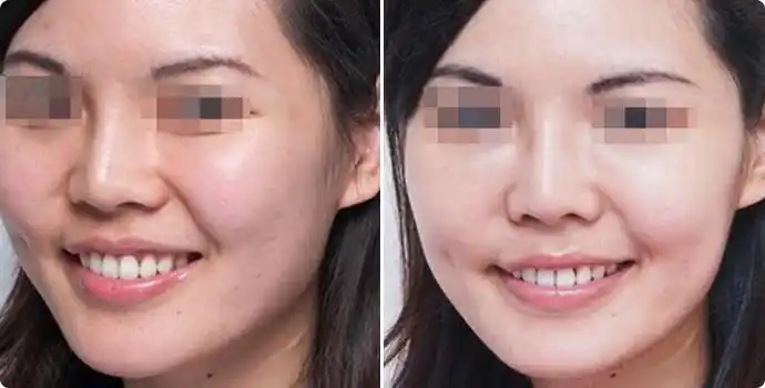 美白注射前后对比图美白注射效果图美白注射前后对比照片