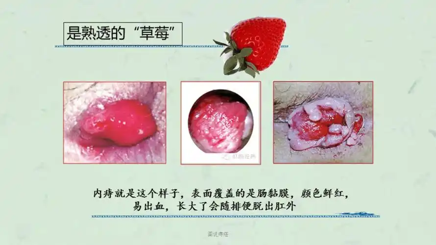 图说痔疮课件