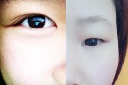 在很多人的印象中,只有双眼皮和单眼皮之分,其实,还有内双眼皮.