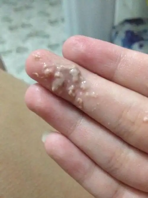 此时女性的白带会混有豆腐渣状白带像皮一样是不是霉菌呢?