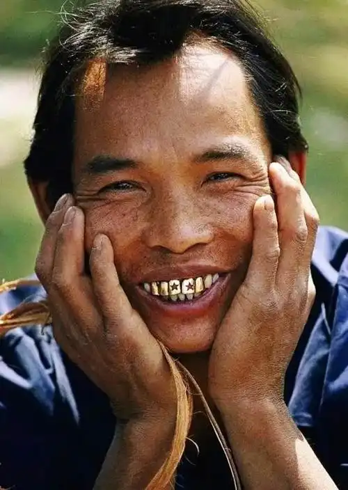 用黄金补牙导致牙齿被偷镶金牙真那么时髦