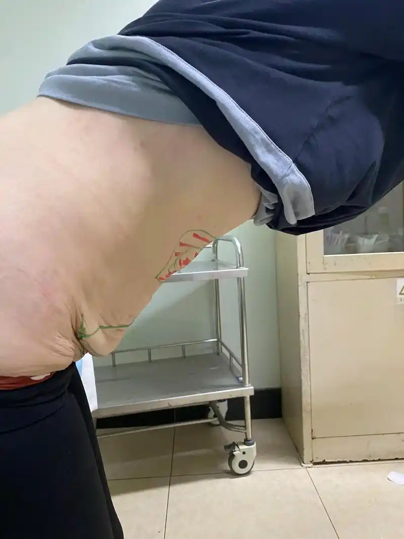 减重术后的皮肤松弛.