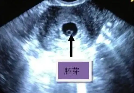 一般在停经42天左右,孕囊中可以出现胚芽,这个胚芽将会逐渐发育成为