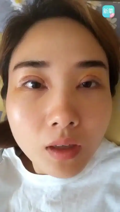 提问帖全切双眼皮第四天眼窝凹陷所以脂肪填充了一下听说脂肪填充不能