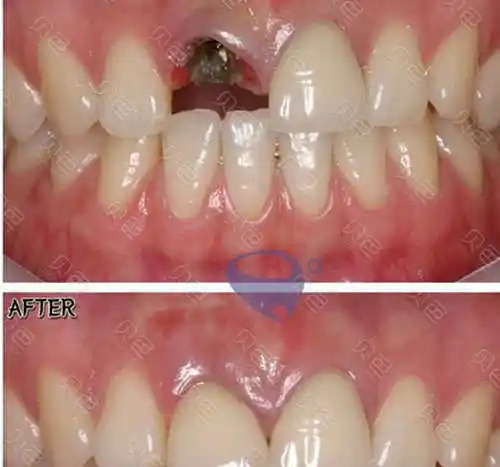 种植牙松动是什么原因如何避免种植牙松动这几点必看