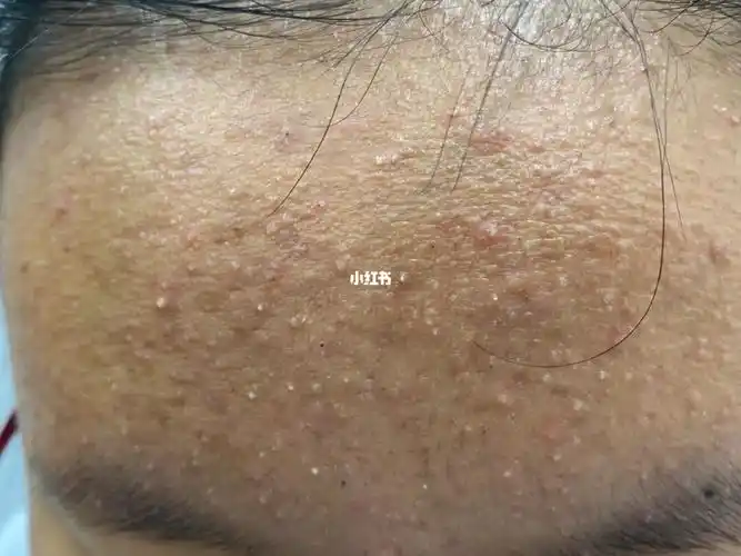 额头上起粉刺痘痘怎么办