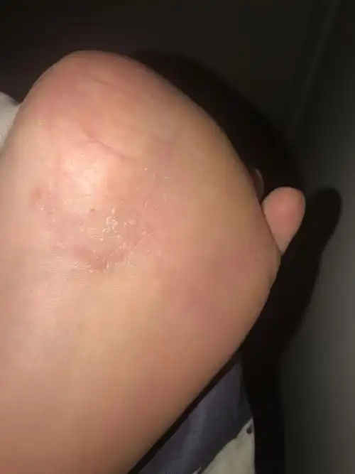 我的脚心怎么了好痒长了一堆痘