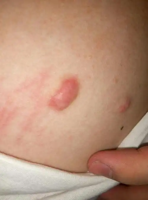 胸前长了个疙瘩,好长时间了,具体时间记不得了,之
