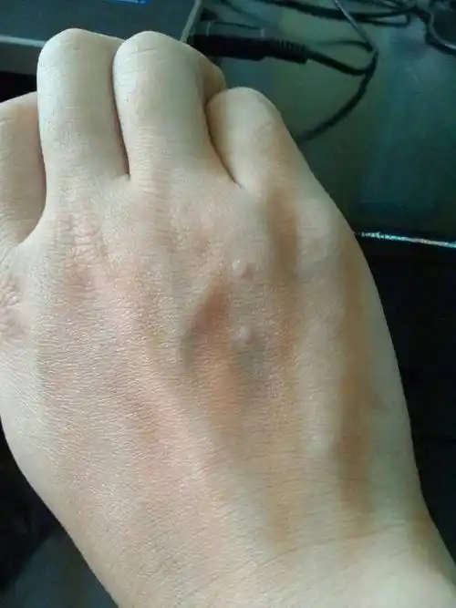 问:请问手上那2个白点是否是扁平疣,是否会变多