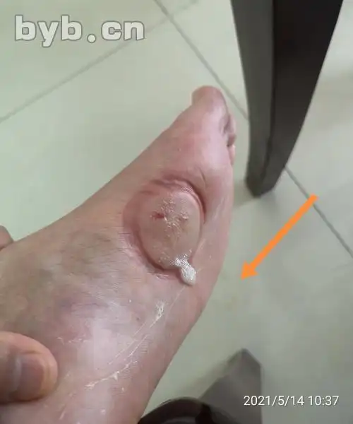 拔罐治脚气 一罐定乾坤