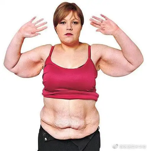 很多人担心做完吸脂后,皮肤会变松垮,真的会出现这种问题吗?