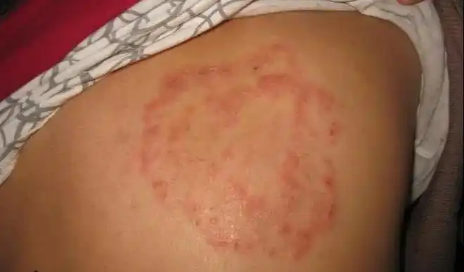 新版中国体癣和股癣诊疗指南,学习一下不错!