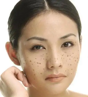 脸部色斑