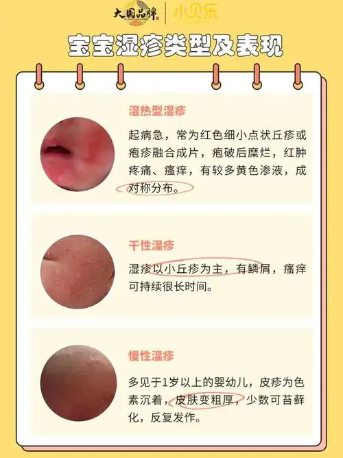 医治上万湿疹娃后他被誉为湿疹克星