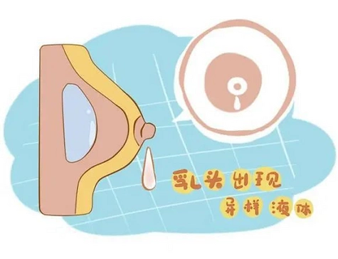 >院网首页>健康学堂>女性健康>正文妇幼健康科普:病理性乳头溢液178