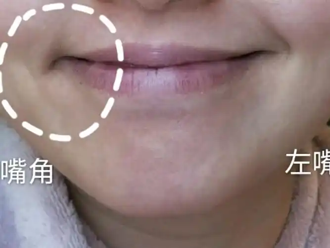 从小就这样,右嘴角笑起来肌肉厚厚的僵僵的,像一直有块肉堵住,右嘴角