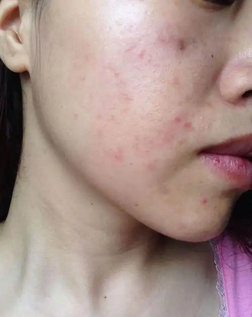 朵嘉浓玫玫;敏感皮肤总是发烫发痒泛红该怎么办|过敏|隔离霜|玫玫