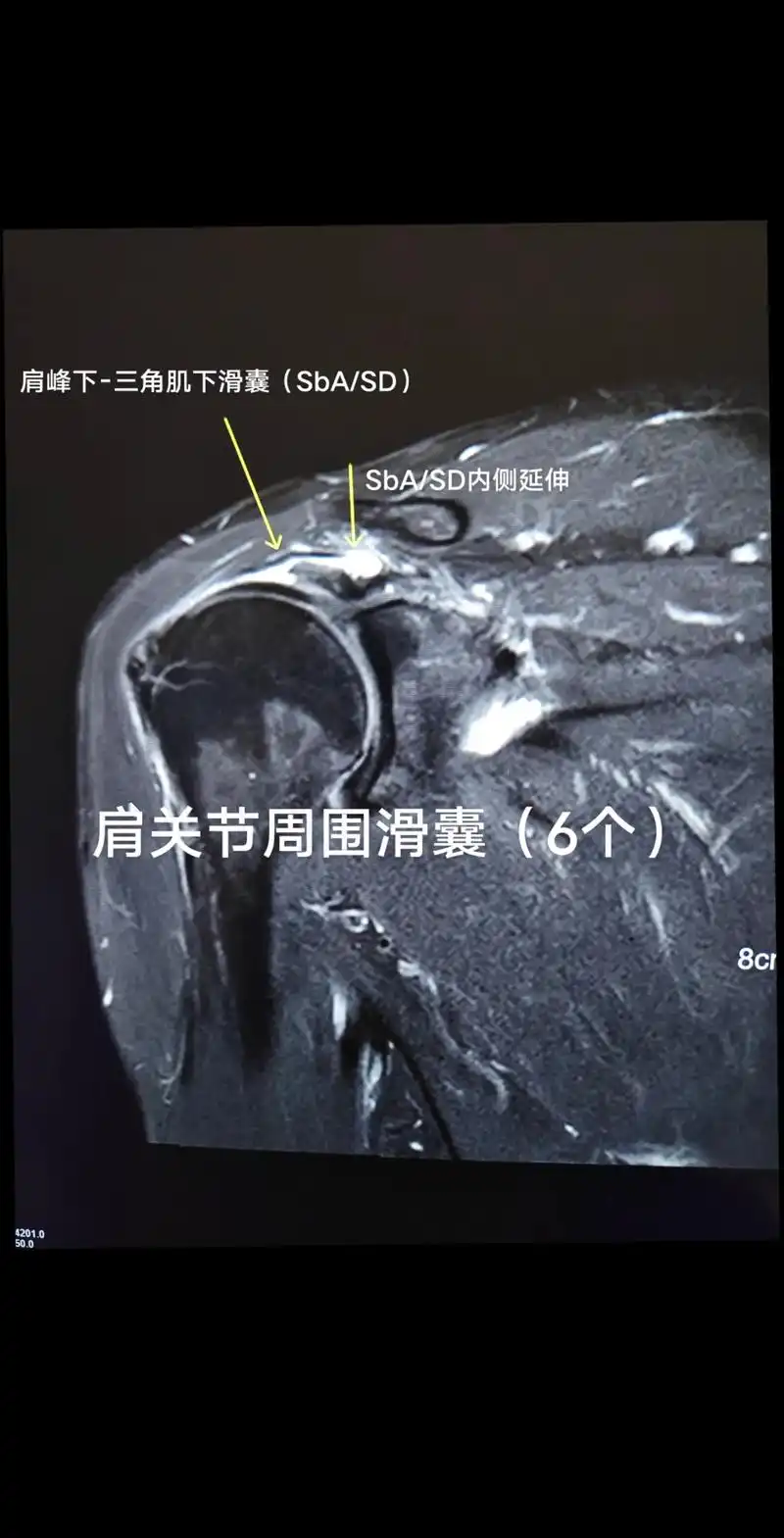 肩关节周围的滑囊(6个):1,肩峰下-三角肌下滑囊(sba/ - 抖音