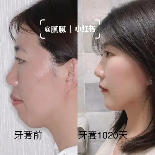 牙套1027天骨性嘴凸不要放弃换头效果