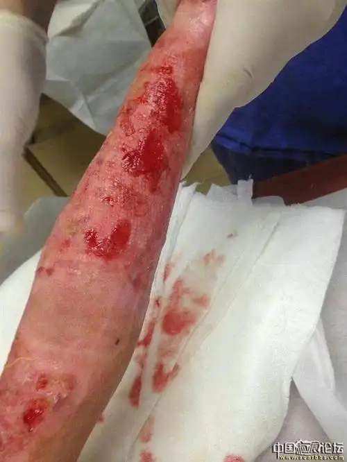 李高令青岛大康医院2015年接治第十三个受伤孩子(香港)