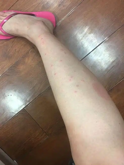 我腿上长对称形疙瘩,痒,不疼,请问是过敏还是湿疹?